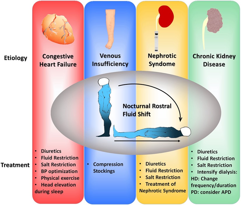 Edema and Obstructive Sleep Apnea